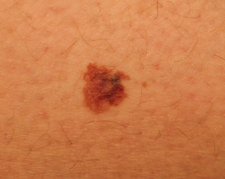 EUROMELANOMA DAY 2014 – Gli esperti: attenzione ai bambini nati nei mesi primaverili